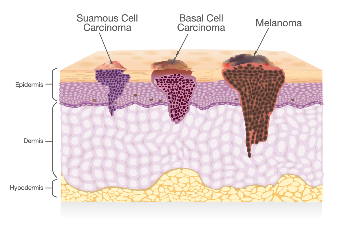 Skin Cancer Cells Types